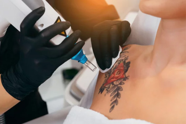 Tattoo Removal