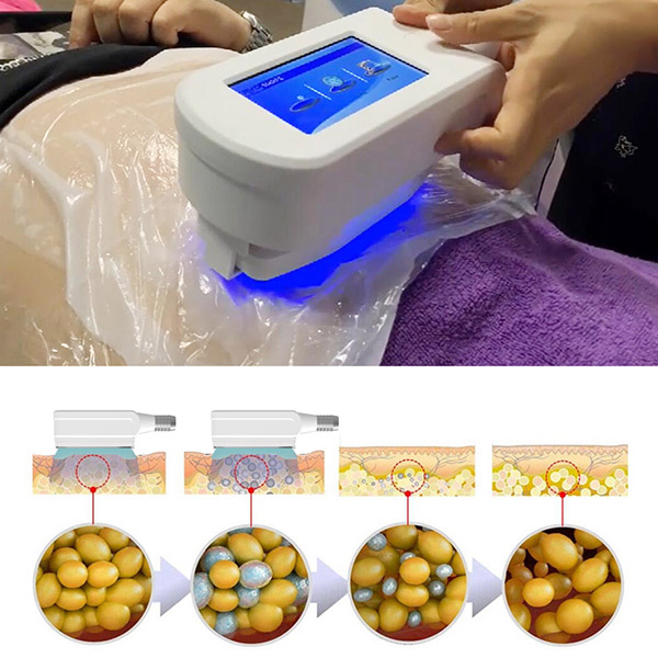 cryoskin machine cryslim machine cryolipolysis machine