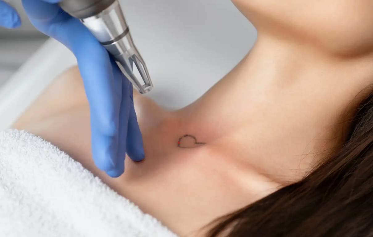 Laser Tattoo Removal Machine