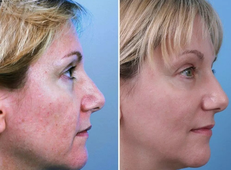 CO2 Laser Resurfacing 1