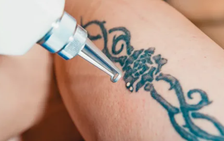 Laser Tattoo Removal